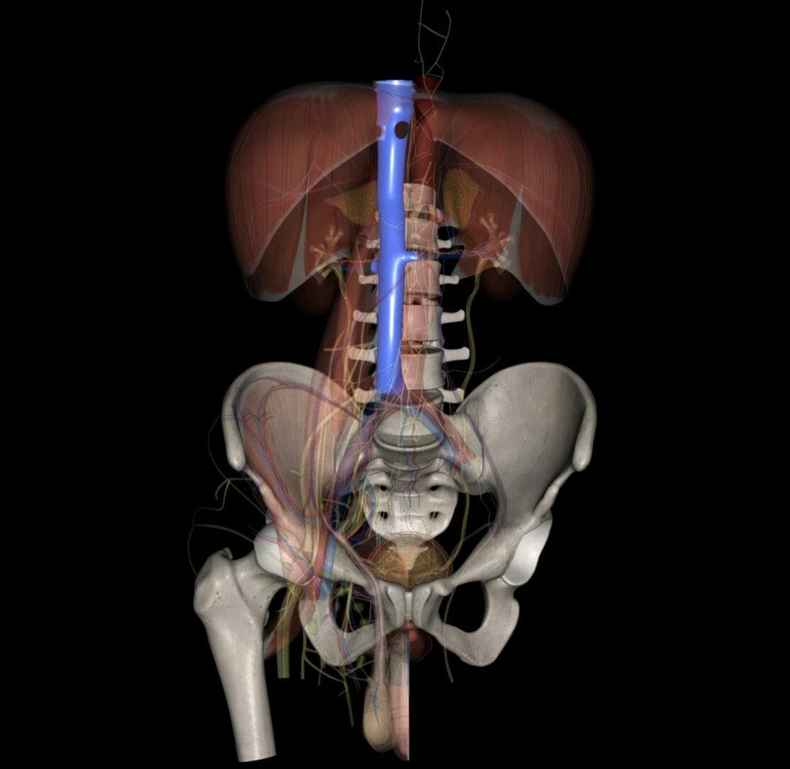The inferior vena cava (IVC) is a large retroperitoneal vessel formed by the confluence of the right and left common iliac veins